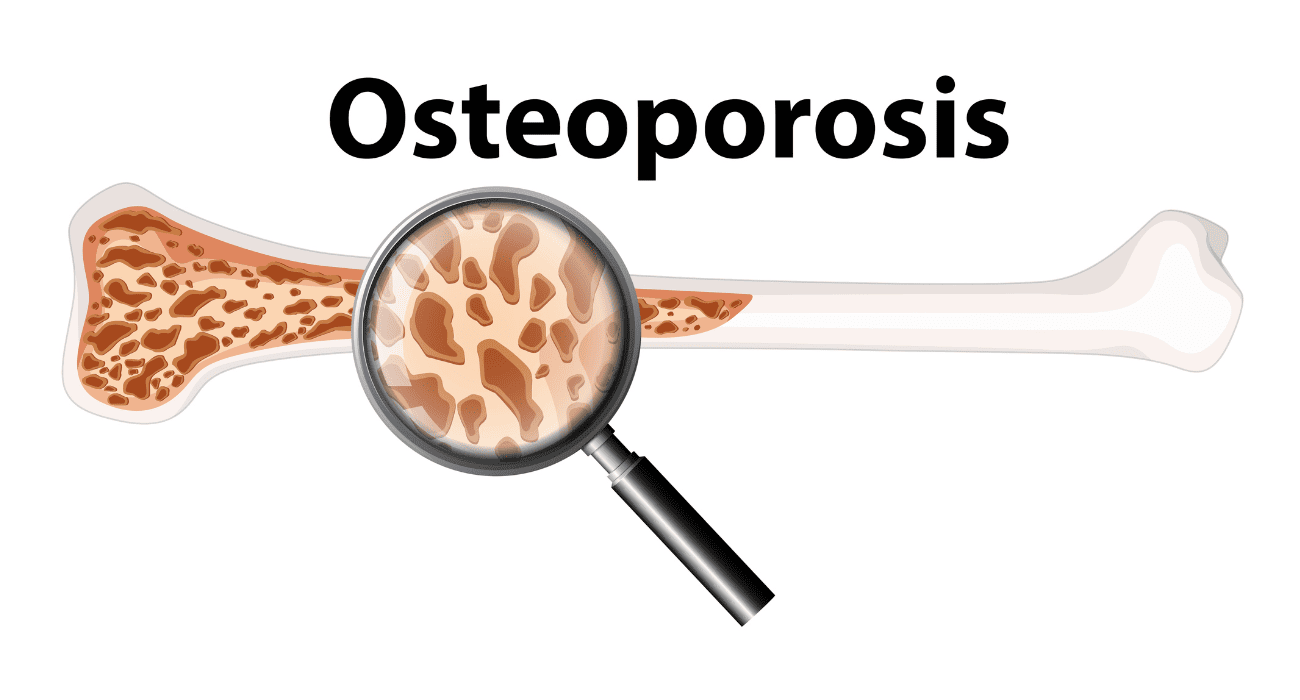 Osteoporosis Treatment